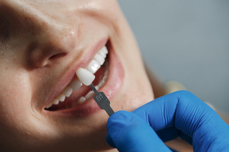 Veneers Fix Your Smile