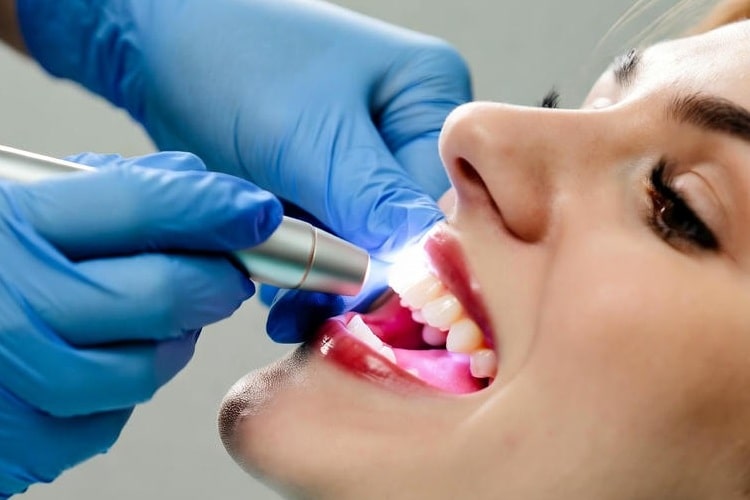 teeth whitening by dentist