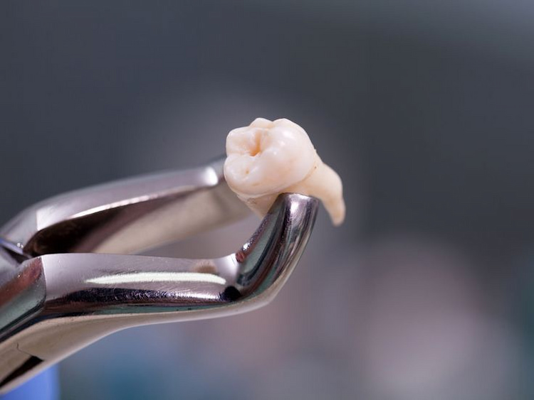 Complications of Wisdom Teeth