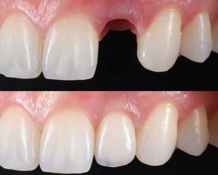Veneers Fix Your Smile