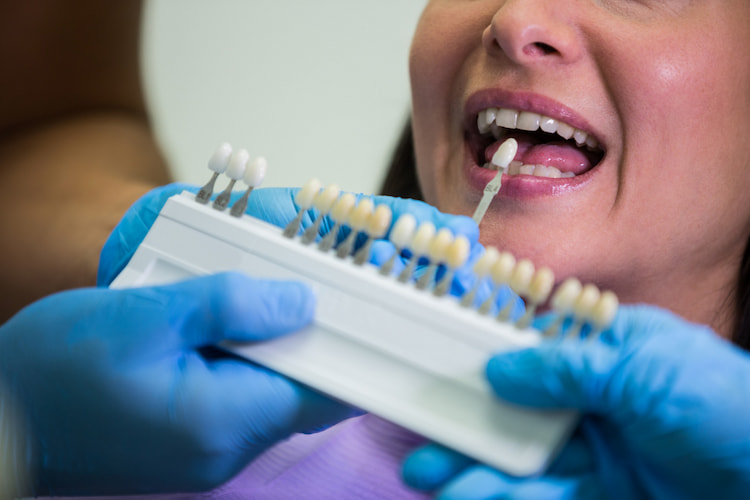 Care for Your Veneers