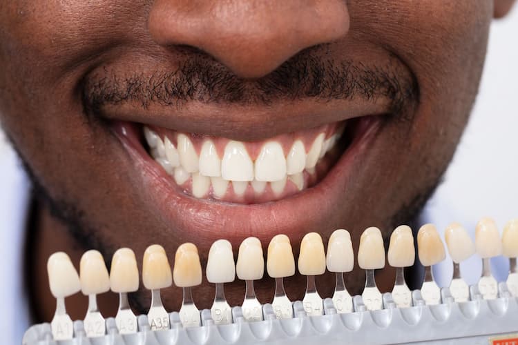Right Material for Your Dental Veneers