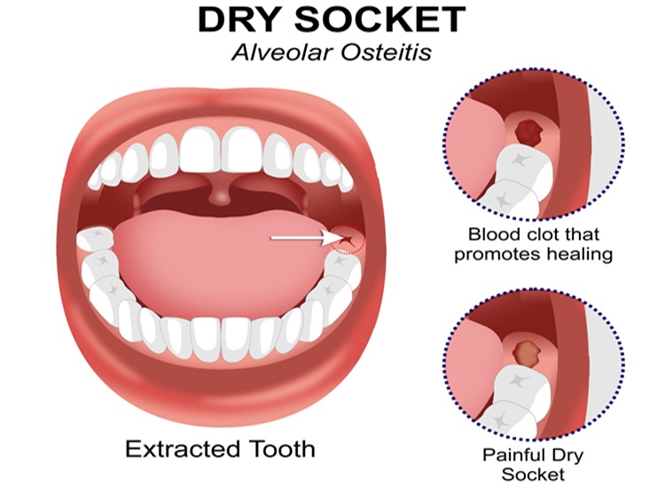 dry socket infographic