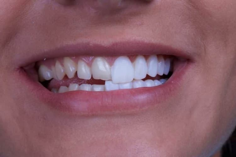 Care for Your Veneers