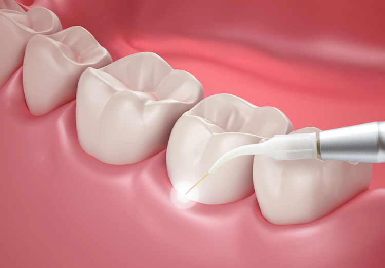 dental cosmetic treatment
