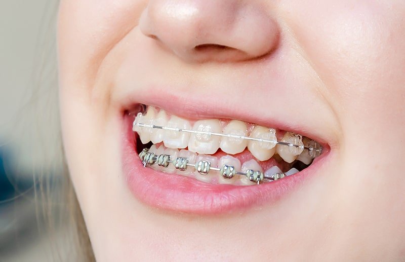First-Class Invisalign Services in Toronto