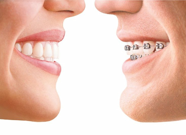 What Are Invisalign and Traditional Braces?