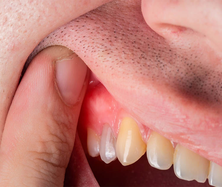 Dental Abscess Treatment - Emergency Dental Services Toronto