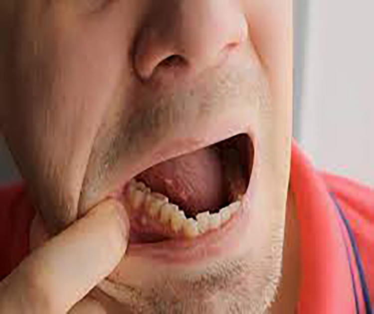 Dental Infections - emergency dentist Toronto