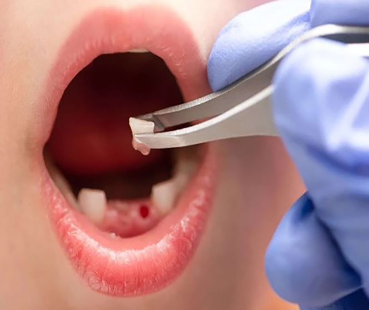 Emergency Tooth Extraction​