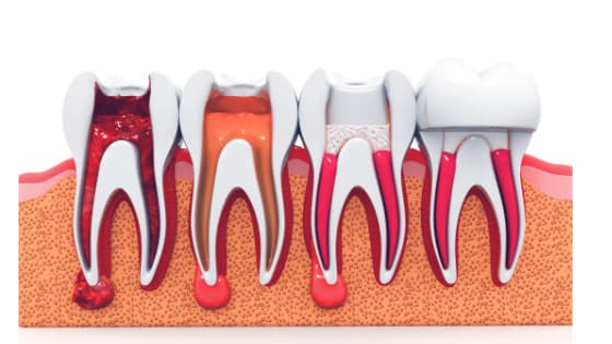 Signs You Might Need a Root Canal