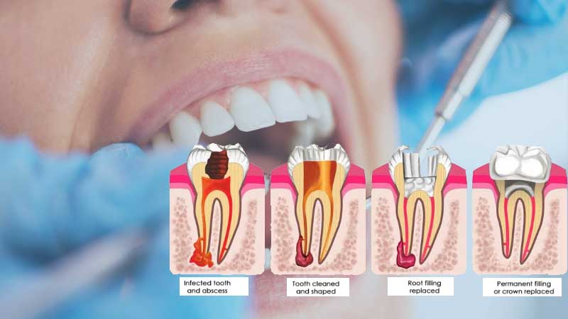 What to Expect from a Root Canal Procedure