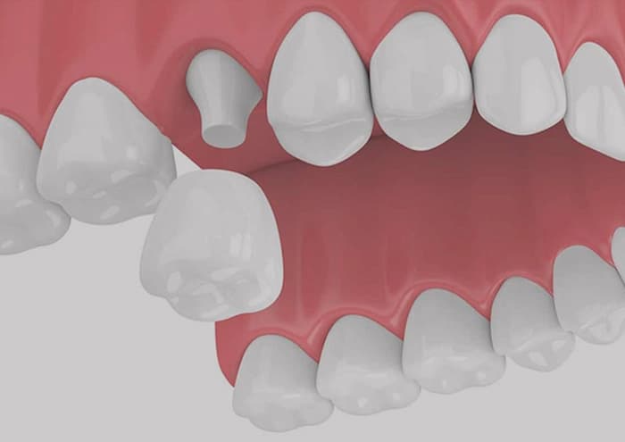 Key Benefits of Dental Crowns
